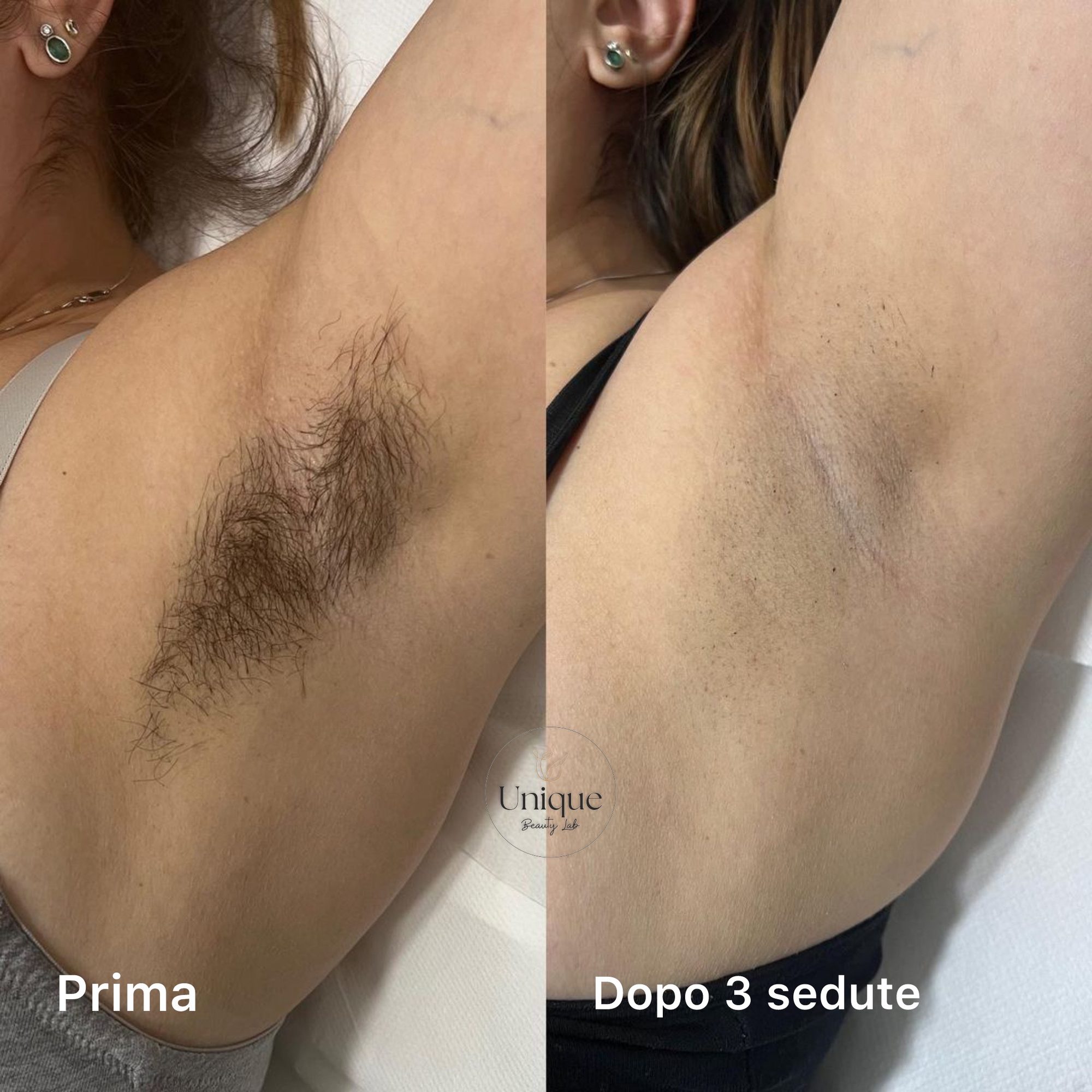 Prima e dopo dell'epilazione laser alle ascelle: pelo fortemente ridotto dopo tre sedute da Unique Beauty Lab