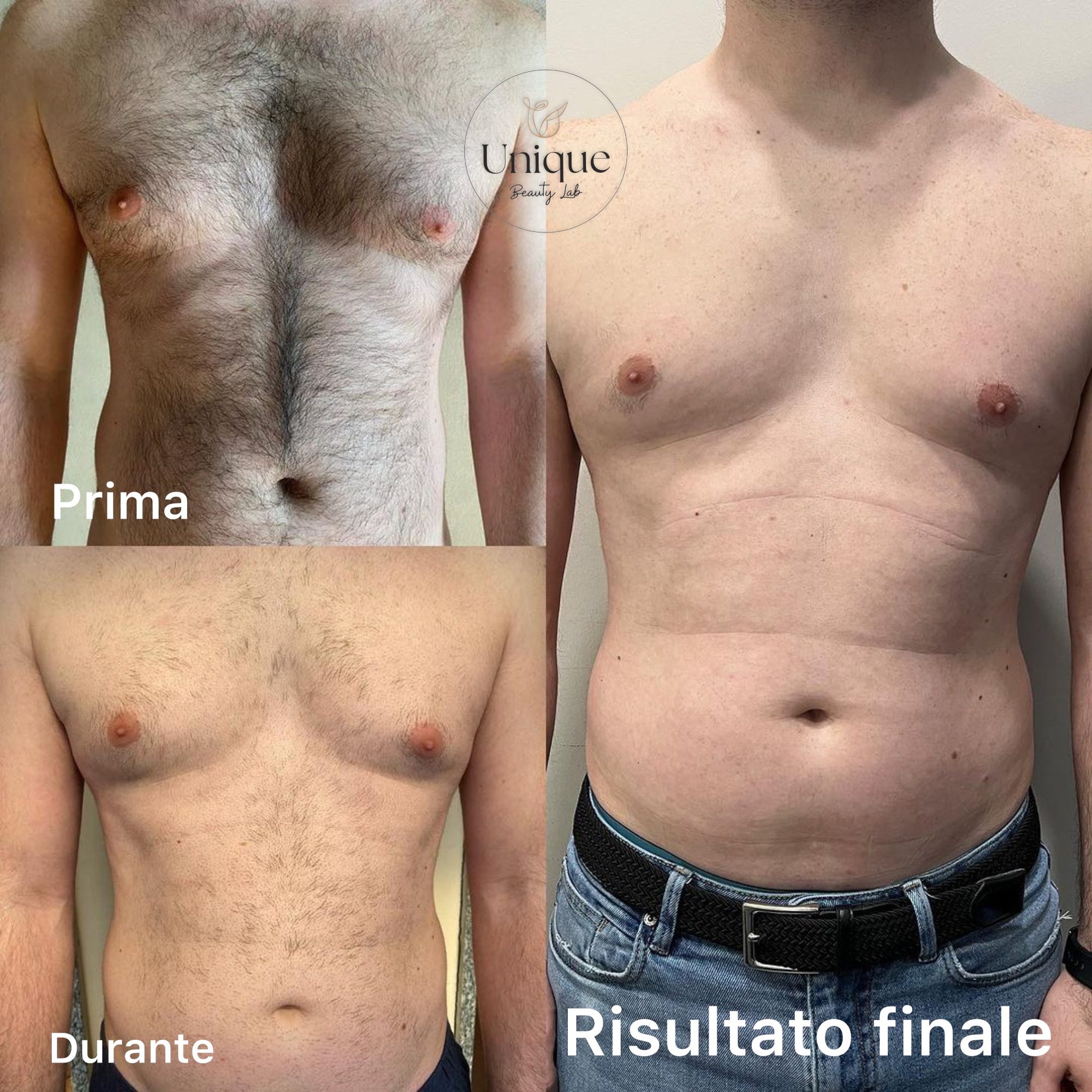 Prima, durante e risultato finale dell'epilazione laser su petto e addome maschili