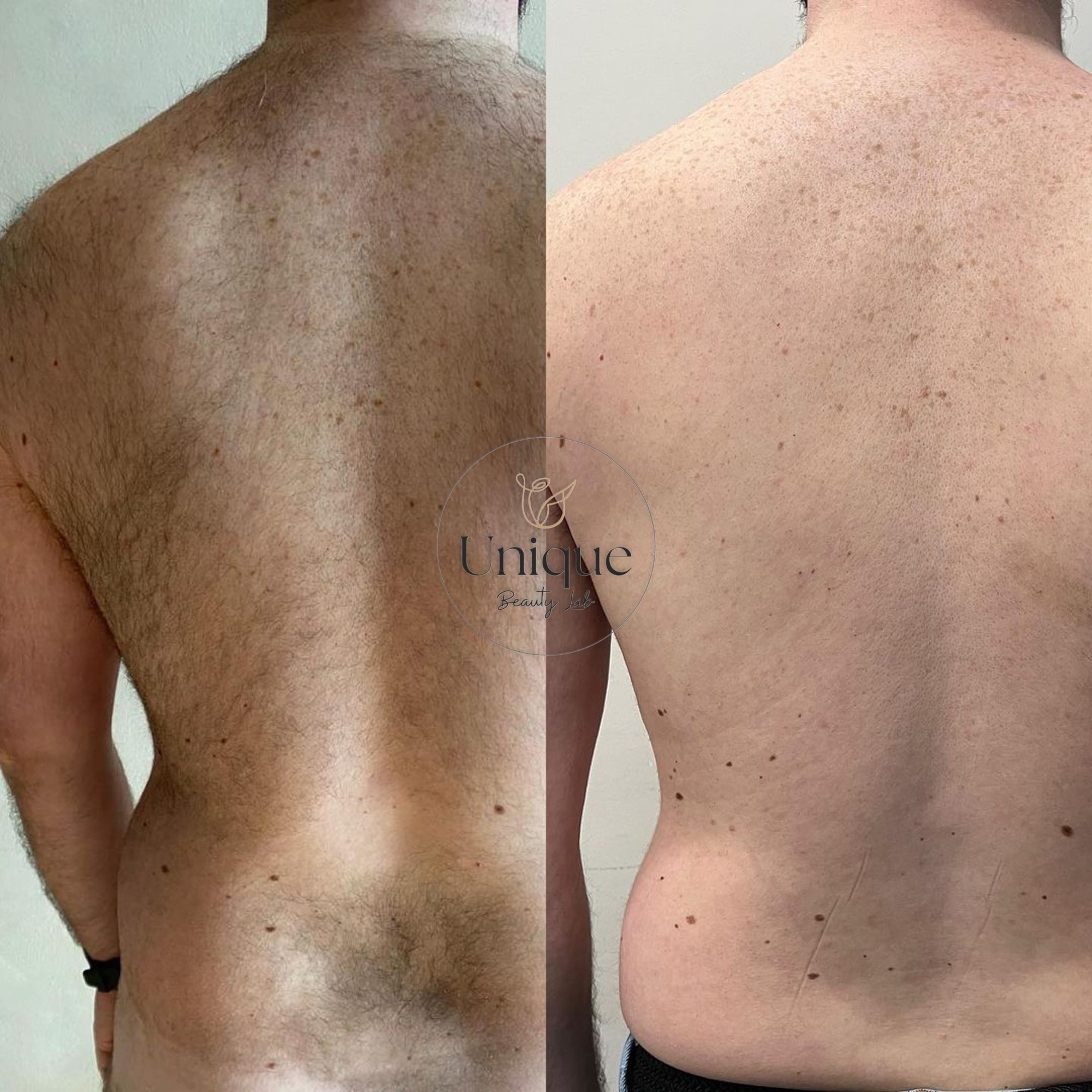 Prima e dopo dell'epilazione laser sulla schiena maschile: pelle liscia e pelo eliminato da Unique Beauty Lab