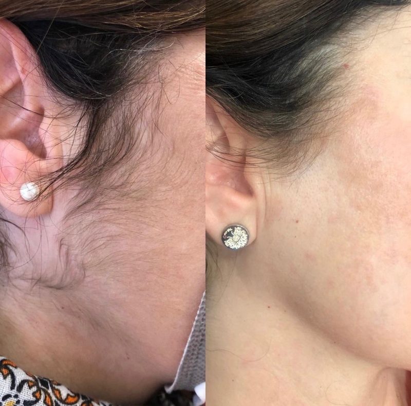 Prima e dopo dell'epilazione laser sulla peluria del viso: pelle liscia su basette, tempia e collo
