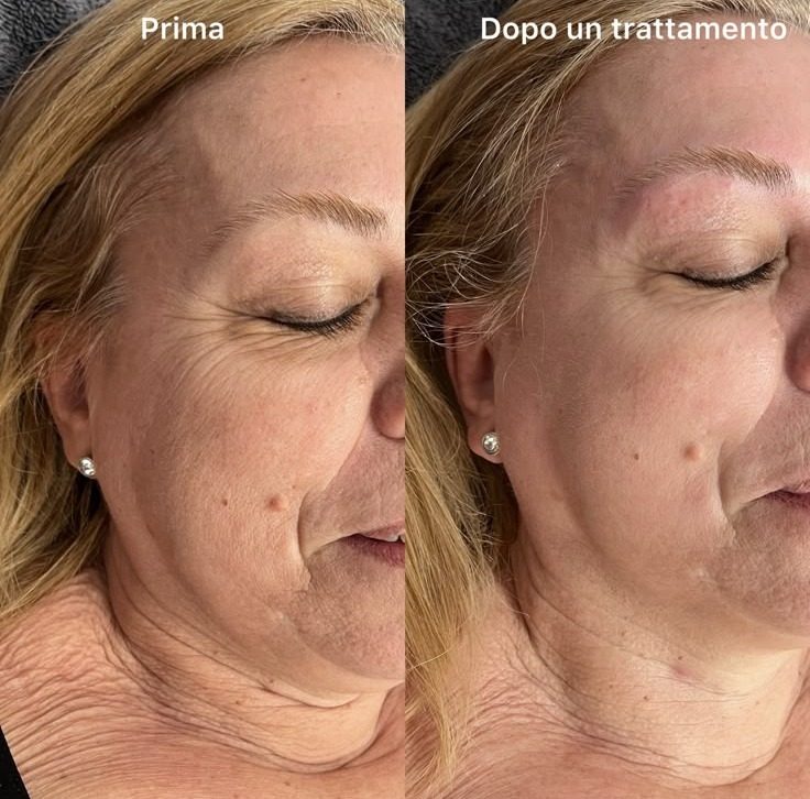 Prima e dopo un trattamento viso: pelle del viso più compatta e levigata dopo una sola seduta