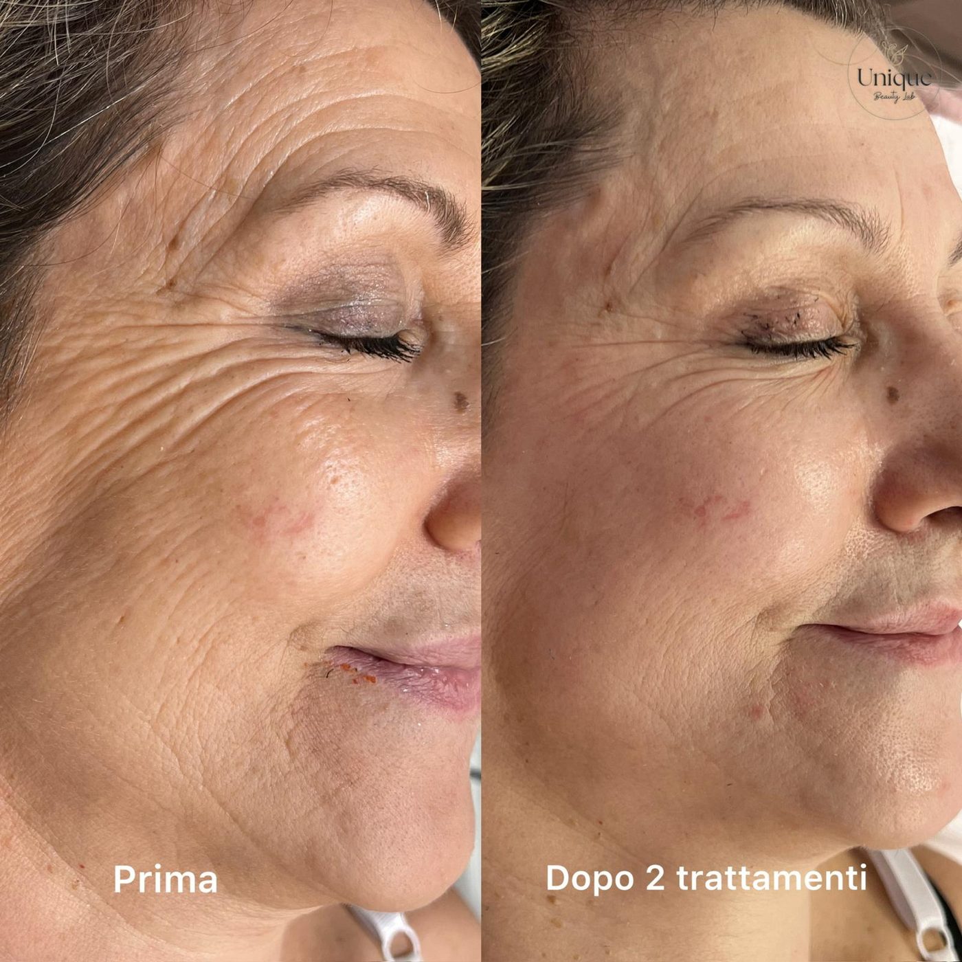Prima e dopo due trattamenti viso: pelle più compatta e distesa, meno rughe
