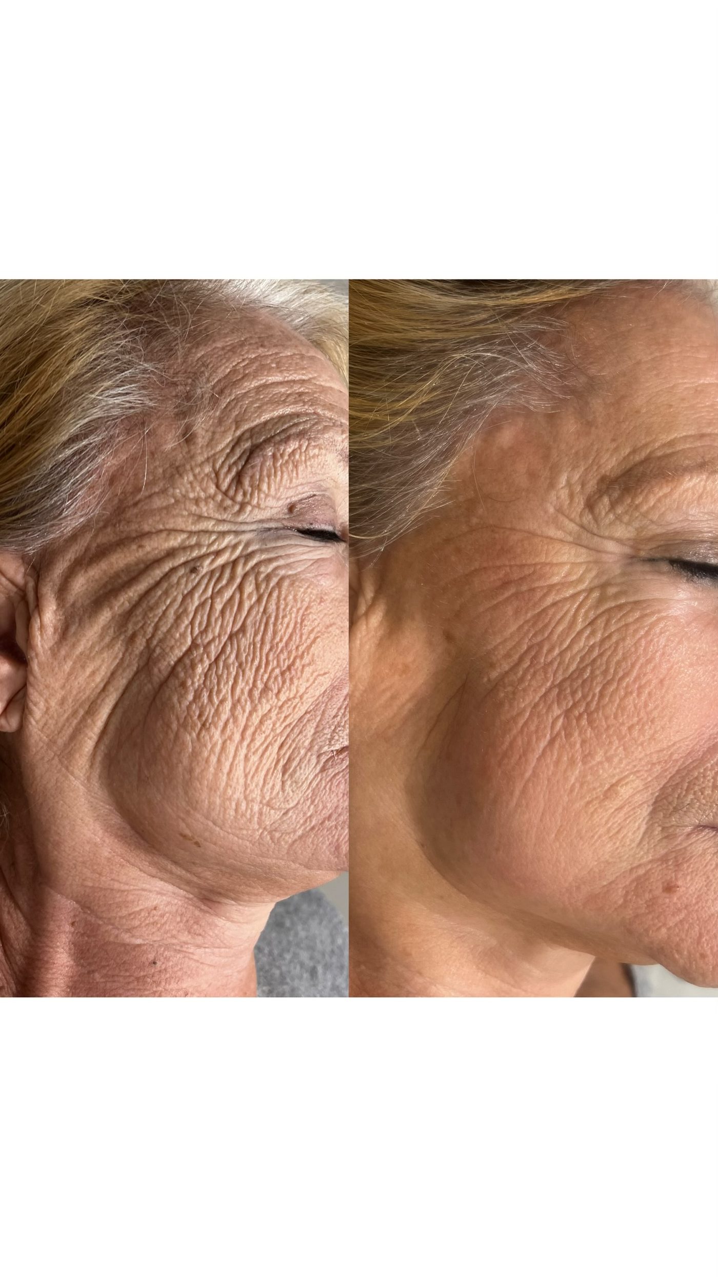 Prima e dopo un trattamento viso antietà: pelle del contorno occhi e zigomo più compatta e distesa